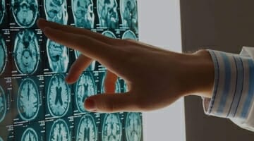 A doctor's hand pointing at a MRI screen, diagnosing a brain injury potentially